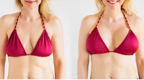 Breast Lift Surgery: A Complete Guide to the Procedure, Benefits, Recovery, and Results